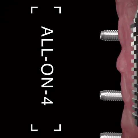 ¿Qué es el All-on-4?