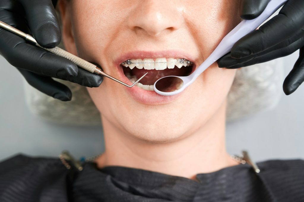 Macro photography of beautiful girl with braces in dental clinic