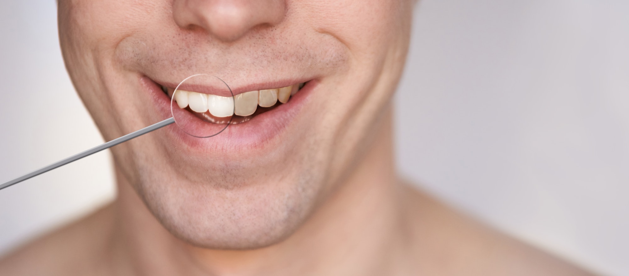 Men smile. Male smiling person. Whitening oral care concept. Teeth before and after. Laughing mouth.