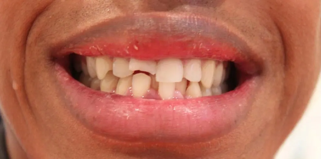 Broken front teeth, before treatment
