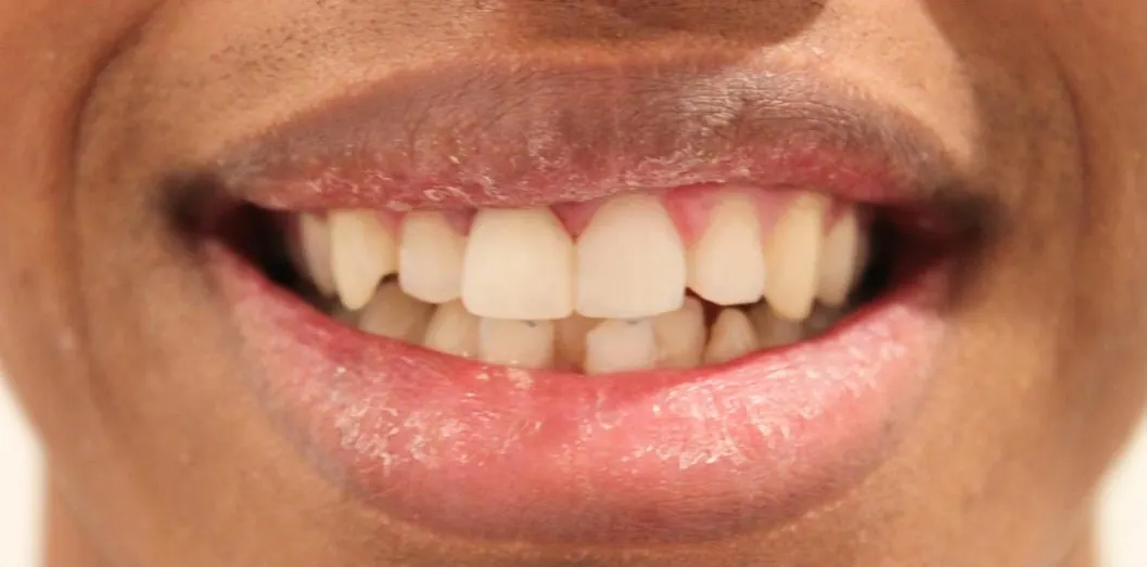 Broken front teeth, after treatment at Metropolitan Smile Design
