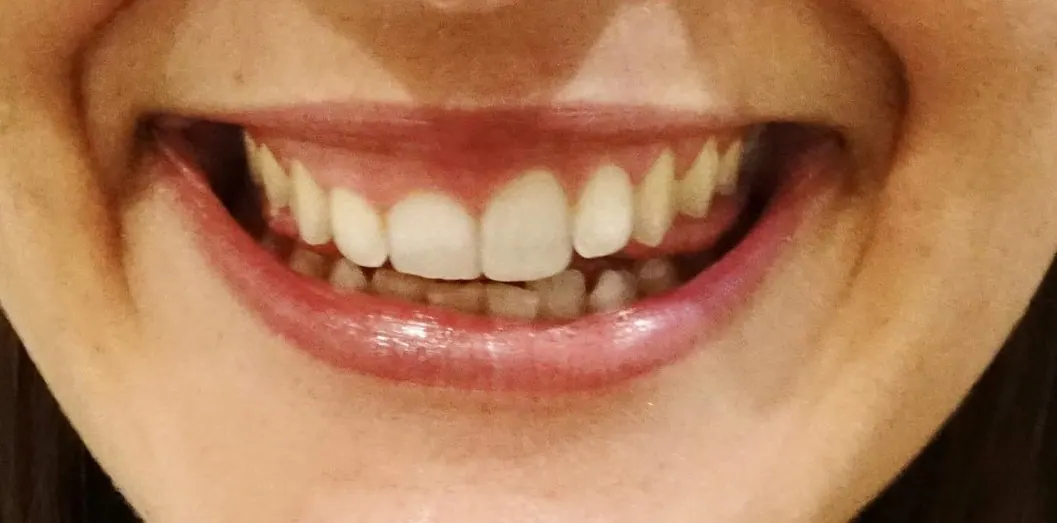 Gum lift, before treatment