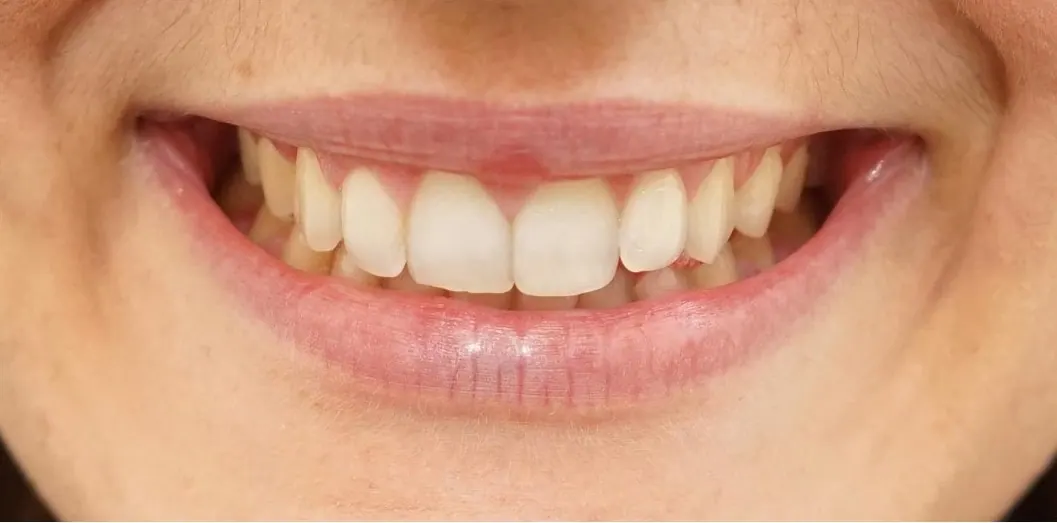 Gum lift, after treatment at Metropolitan Smile Design