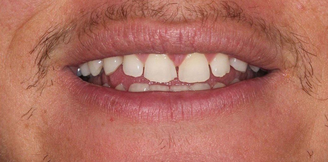 smiling-dental-porcelain-veneers-1after-16