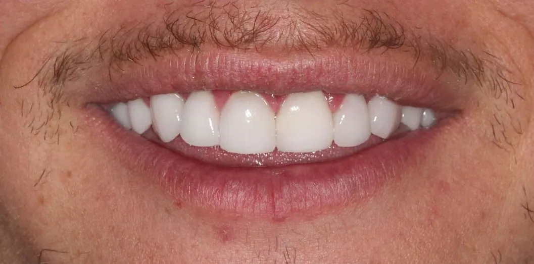 Porcelain veneers, after treatment at Metropolitan Smile Design