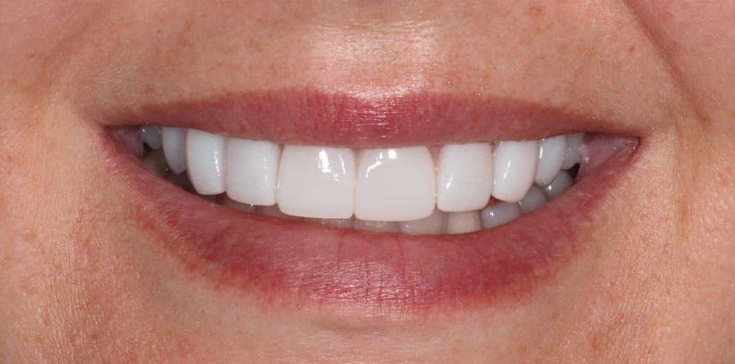 smiling-dental-tooth-bonding-before-after-132-comp1ress