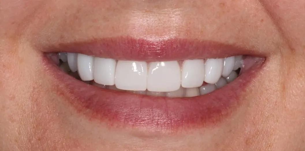 Composite bonding, after treatment at Metropolitan Smile Design