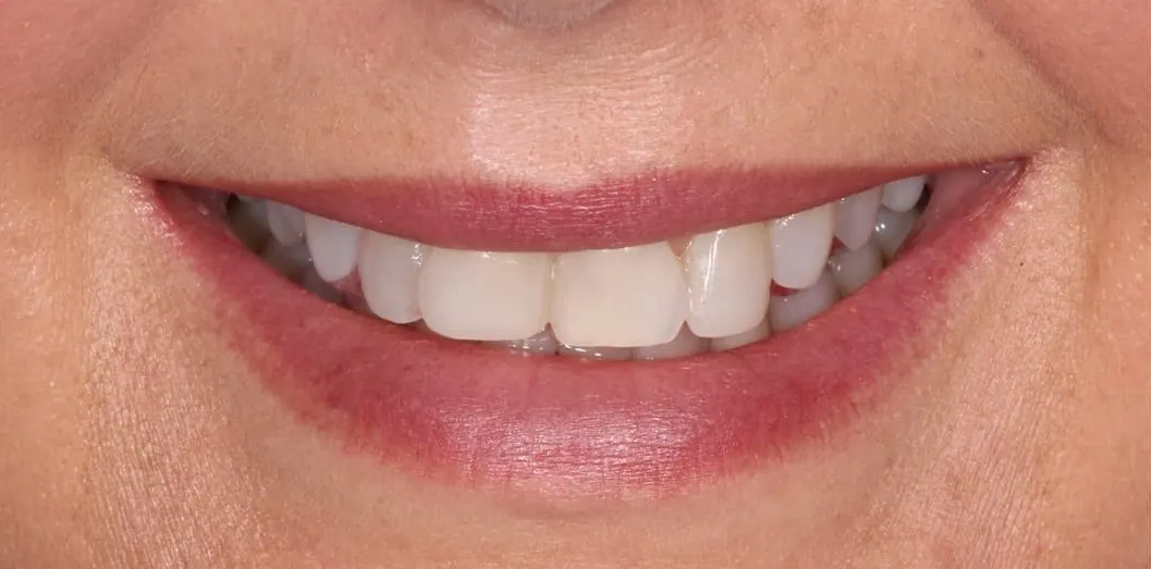 Composite bonding, before treatment