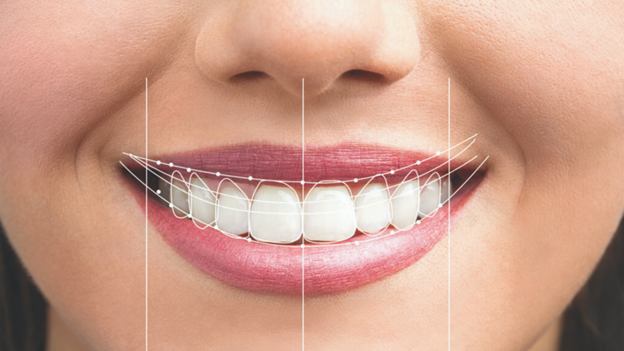 Smile makeover for square face shape