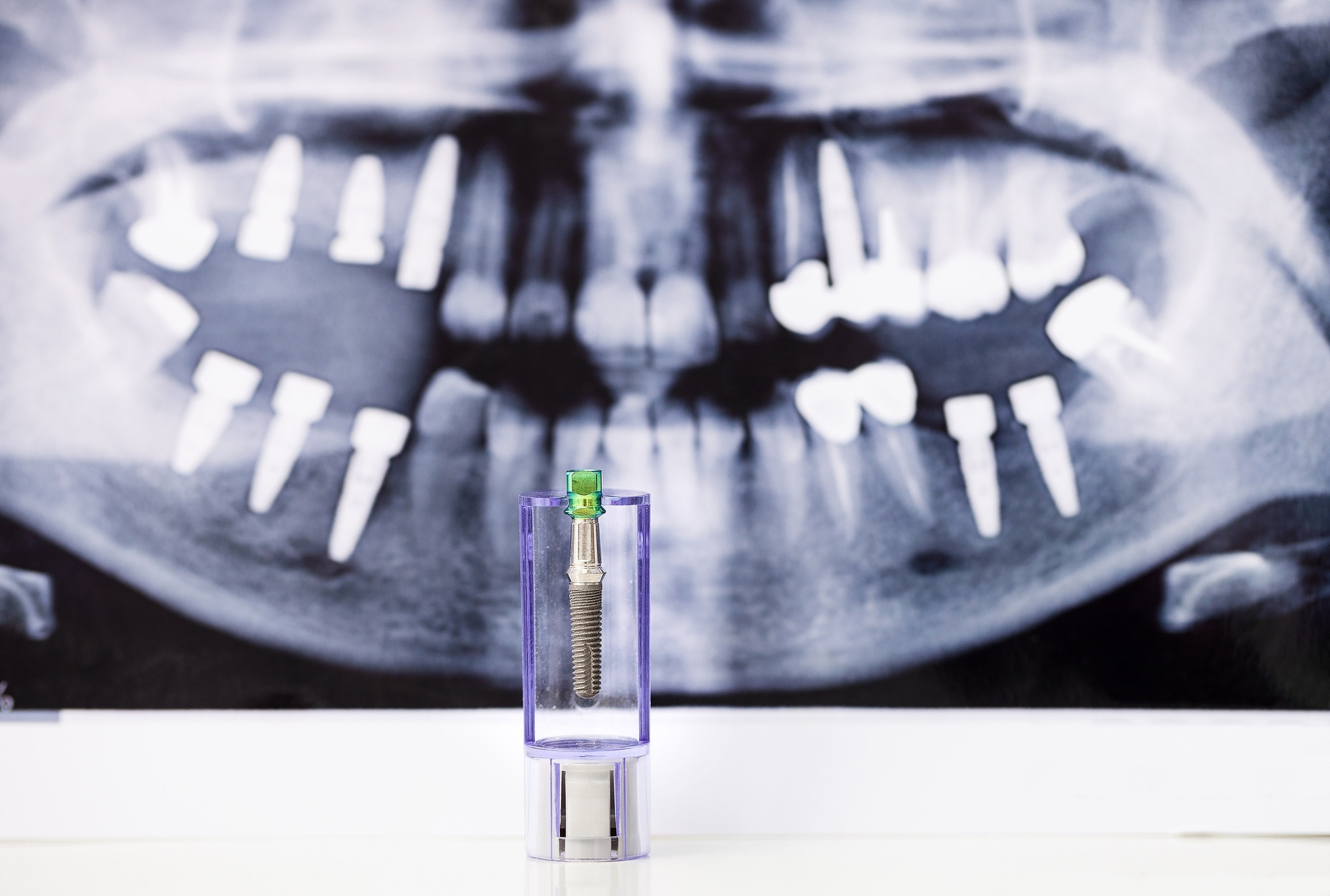 How much are dental implants consultation