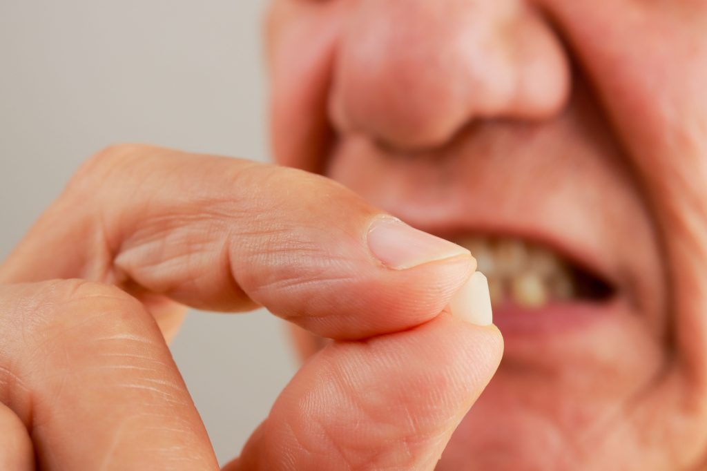 Man demonstrating his chipped tooth between his fingers.