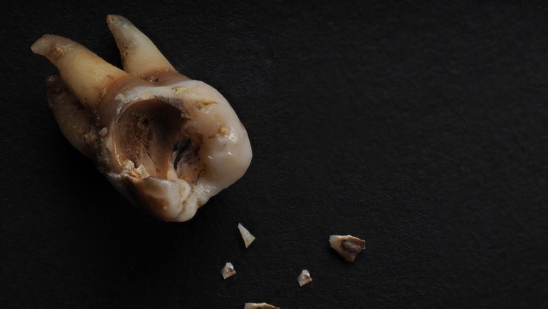 macro shot of a decayed teeth till root after extr 2026 03 19 09 26 48 utc Medium