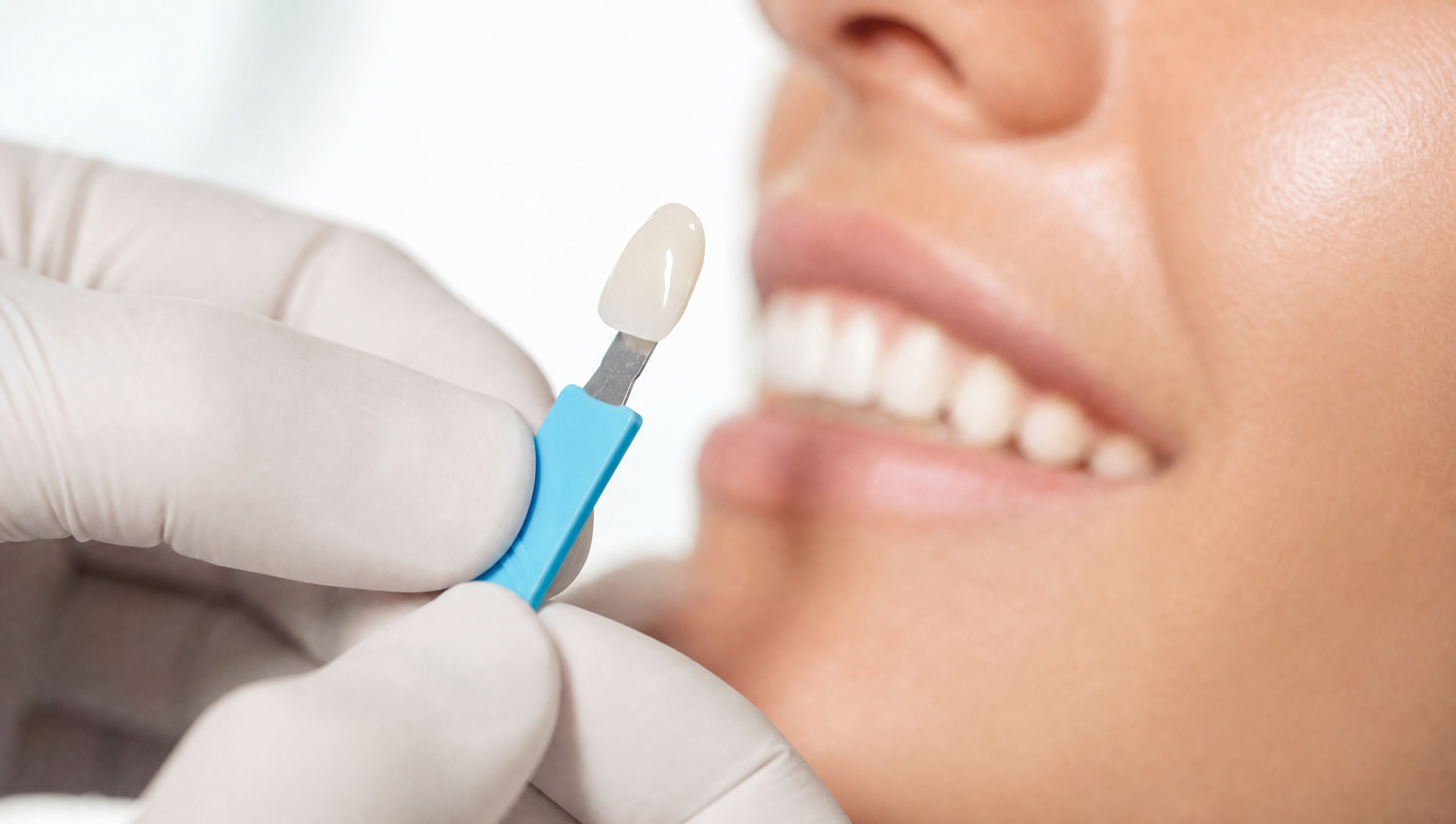Cosmetic dentist Tamarac using porcelain veneer shade guide for color matching