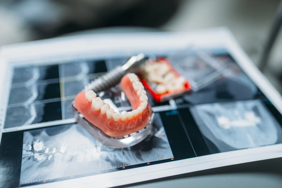 Dentadura postiza completa y un modelo con implantes apoyados sobre radiografías dentales