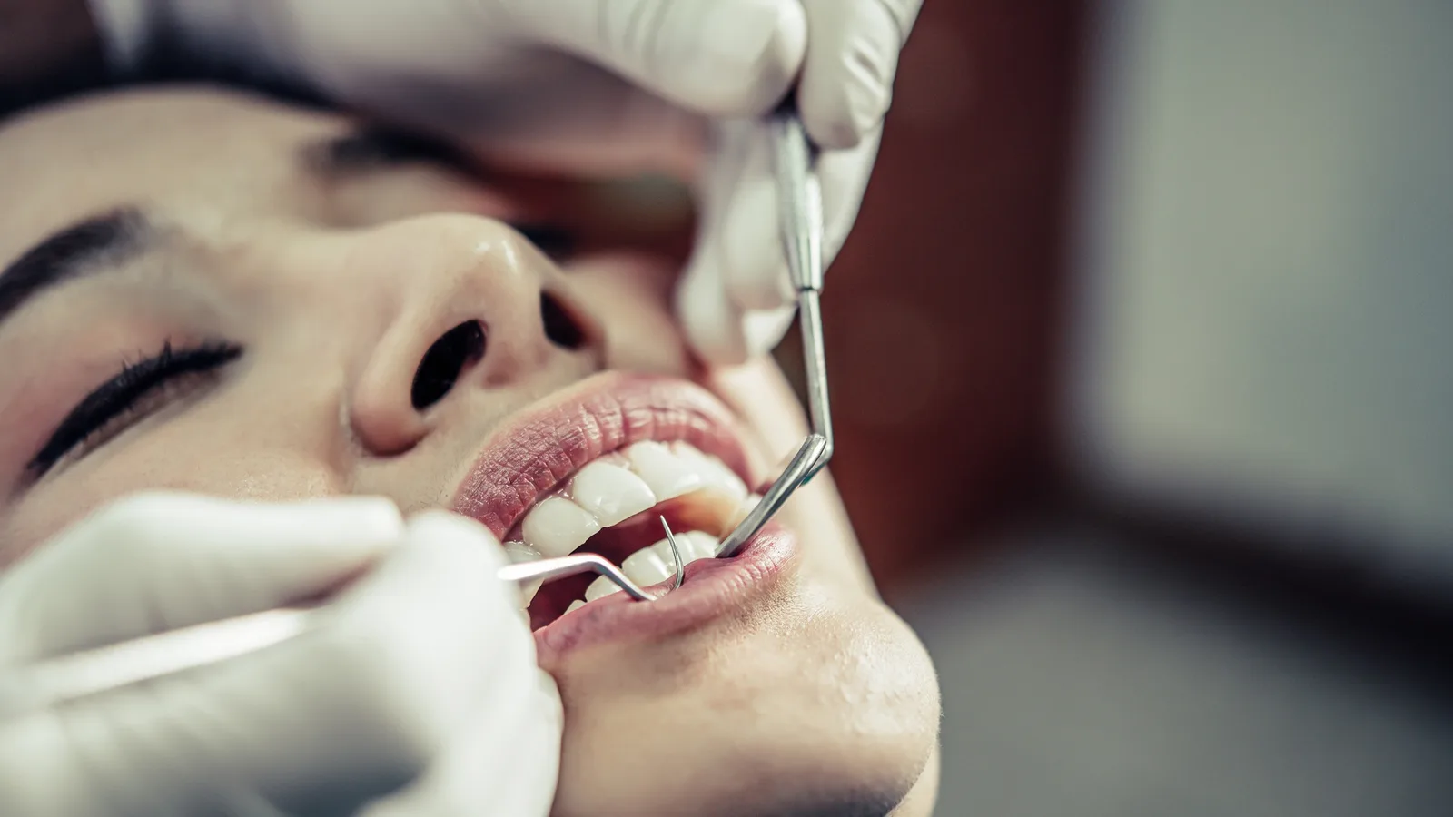 Diente Roto en Tamarac: Qué Hacer en las Primeras Horas y Cómo se Arregla 1 Manos con guantes revisan los dientes de una paciente con un espejo y una sonda dental