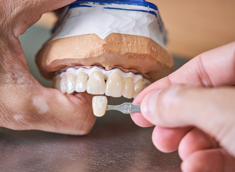 Crop male orthodontist in process of making veneers