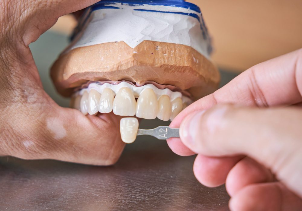 Crop male orthodontist in process of making veneers