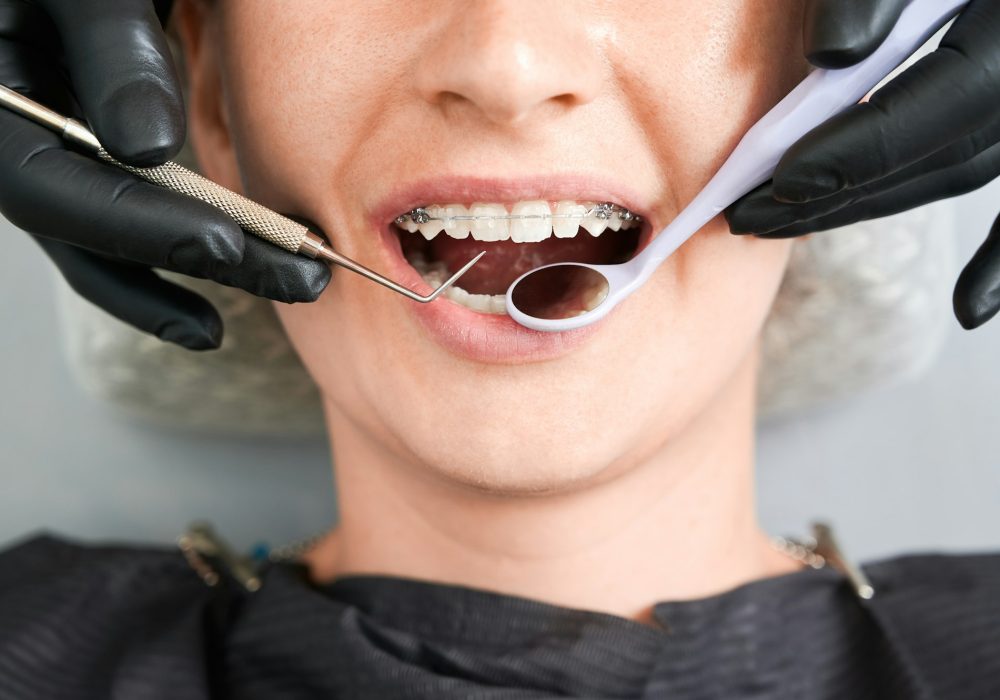 Macro photography of beautiful girl with braces in dental clinic